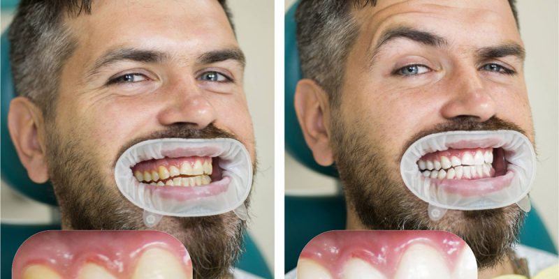 Hvor hvite kan tennene bli