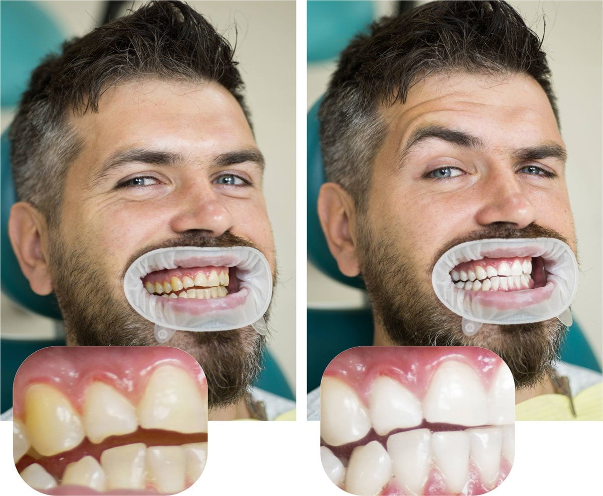 Hvor hvite kan tennene bli